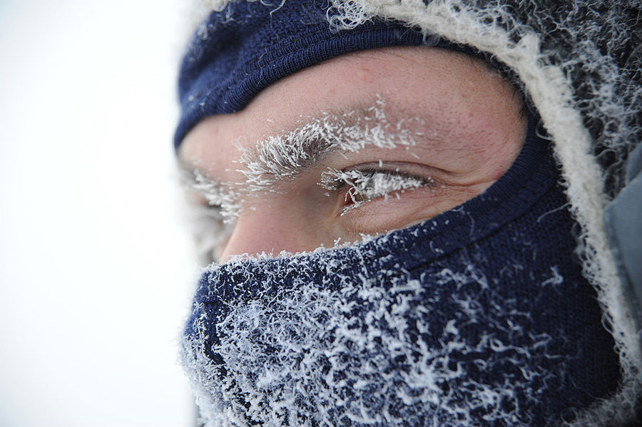 обморожение