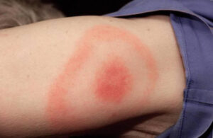 kleschevoy-borrelioz-1