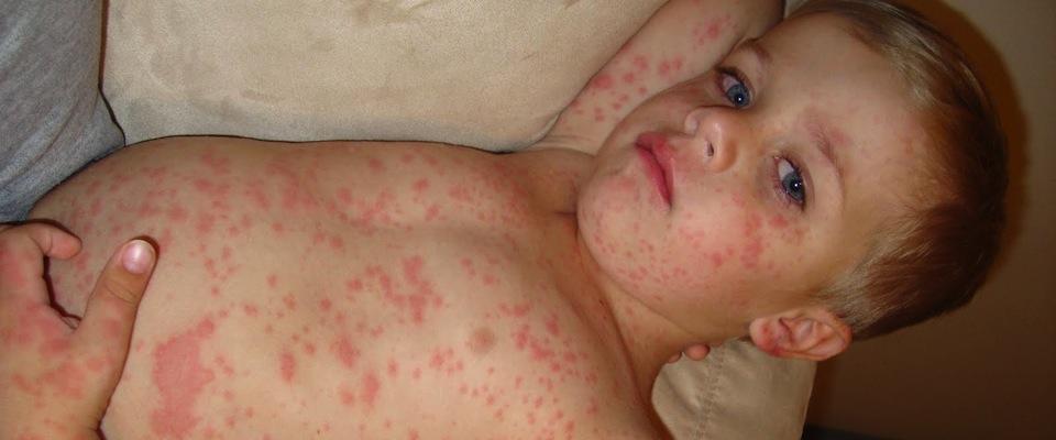 measles