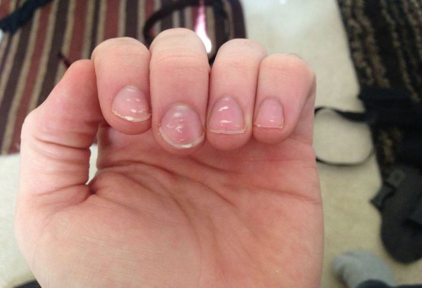белые полоски на ногтях