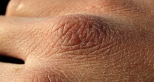 обезвоживание