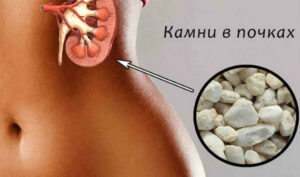 5 продуктов, из-за которых образуются камни в почках