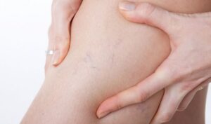 Сосудистые звездочки на ногах: причины и что делать