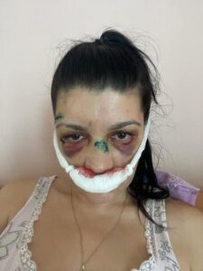 Избитая активистка Эшонкулова рассказала, кто на неё напал