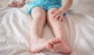 Как избавиться от зуда после укусов комаров: 6 народных средств