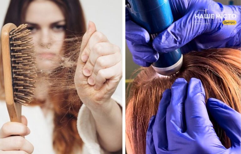 Сезонне випадіння волосся в Дніпрі: де шукати допомогу?