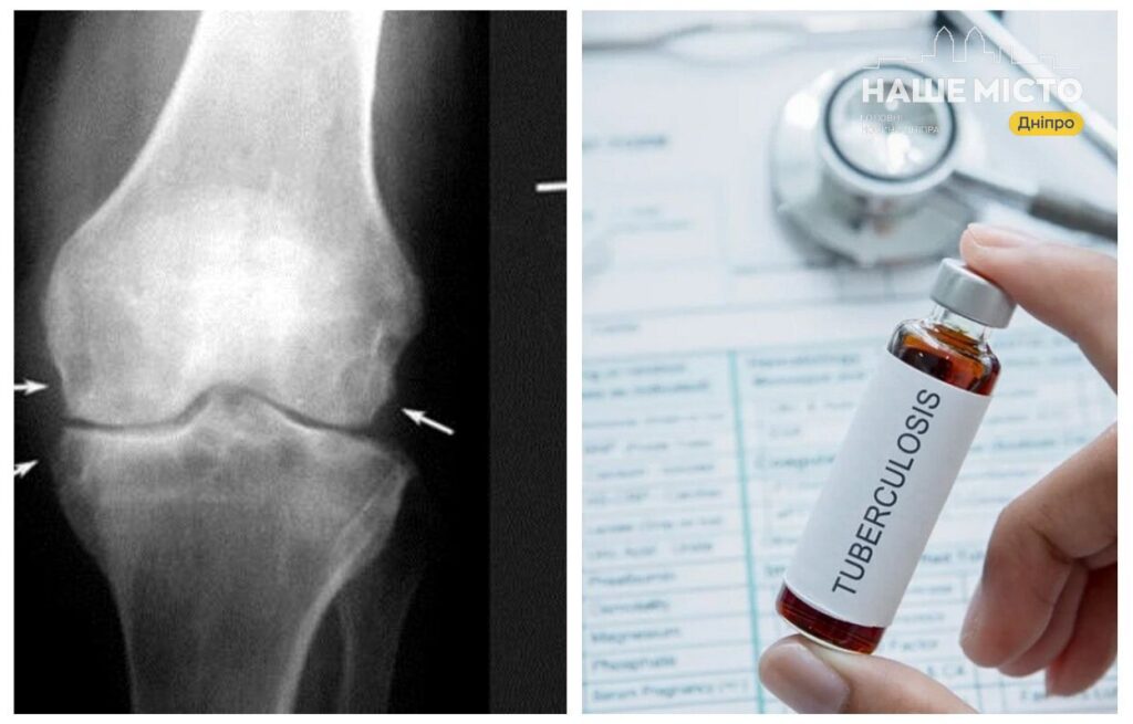 Позалегеневий туберкульоз: симптоми та діагностика в Дніпрі