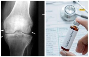 Позалегеневий туберкульоз: симптоми та діагностика в Дніпрі