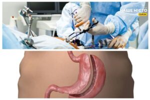 Вартість баріатричних операцій у Дніпрі: що потрібно знати