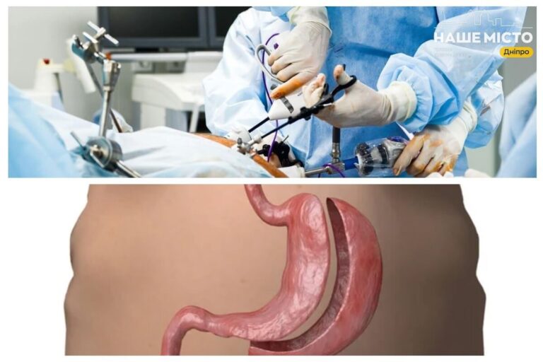 Вартість баріатричних операцій у Дніпрі: що потрібно знати